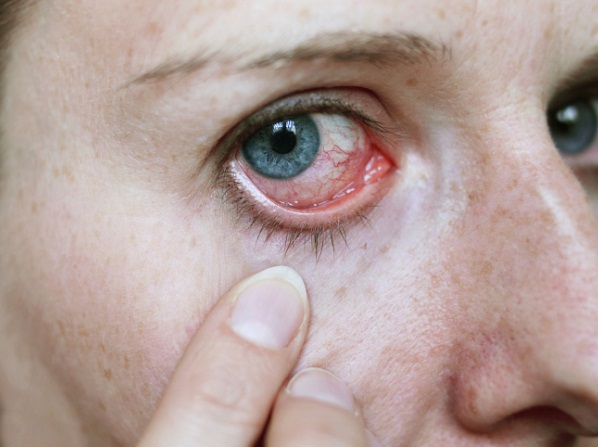 Cancerígenos en los cosméticos y tinturas: mitos y verdades - Puede irritar los ojos o la piel