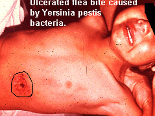 Las 10 infecciones más asesinas  - La peste en tiempos modernos