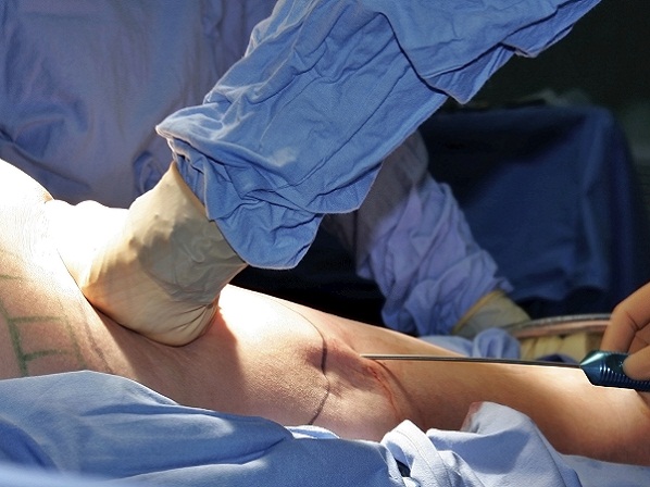 10 cirugías para 10 complejos del cuerpo  - Liposucción: modelar un nuevo cuerpo 