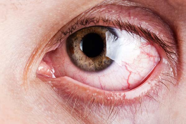 Alergia: ¿episodio aislado o enfermedad crónica?  - Ojeras y ojos llorosos