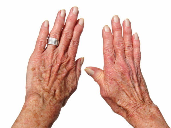 Artritis: afecta a jóvenes, mayores...y a estrellas también - ¿Cómo saber si tengo artritis?