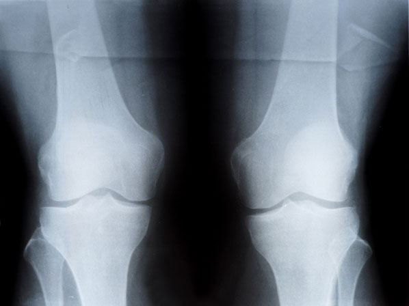 Artritis: afecta a jóvenes, mayores...y a estrellas también - ¿Qué es la artritis reumatoide?