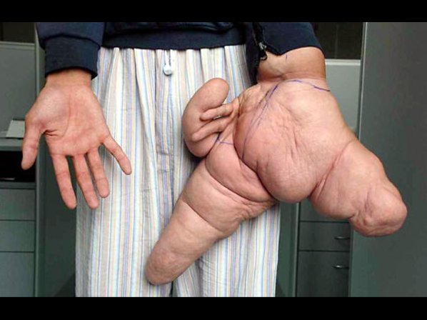 Los 10 cuerpos más extremos - 8. La mano más grande