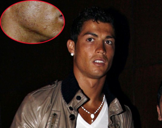 Los famosos también tienen acné - Cristiano Ronaldo