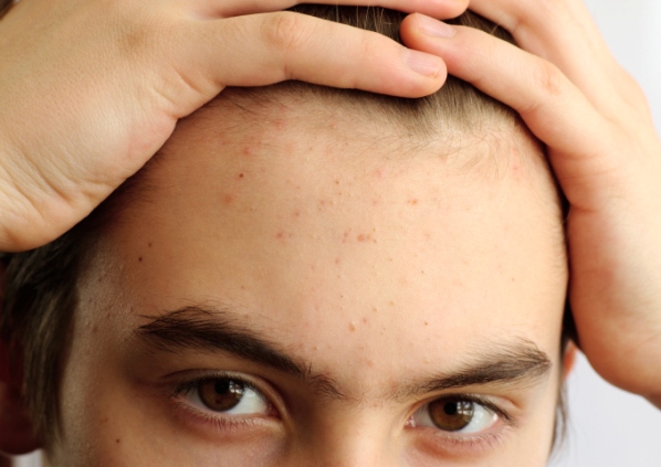 Los famosos también tienen acné - Un virus para curar el acné