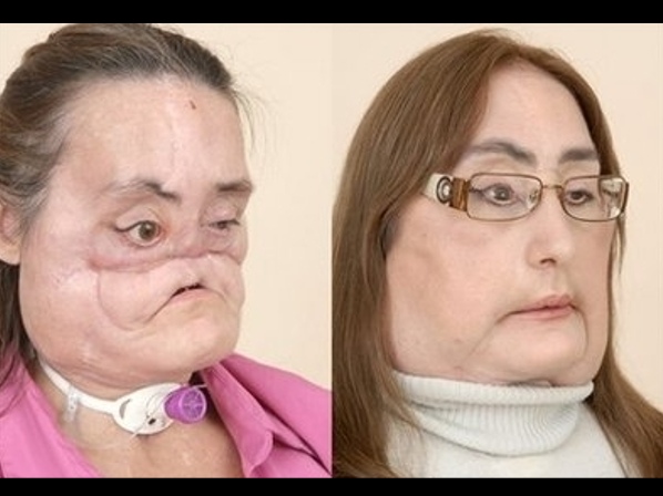 El mayor trasplante de cara jamás hecho - El primero en Estados Unidos