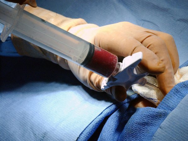 Nuevas esperanzas contra una rara enfermedad de la sangre - No es una cura