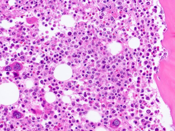 Nuevas esperanzas contra una rara enfermedad de la sangre - ¿Qué es la mielofibrosis?