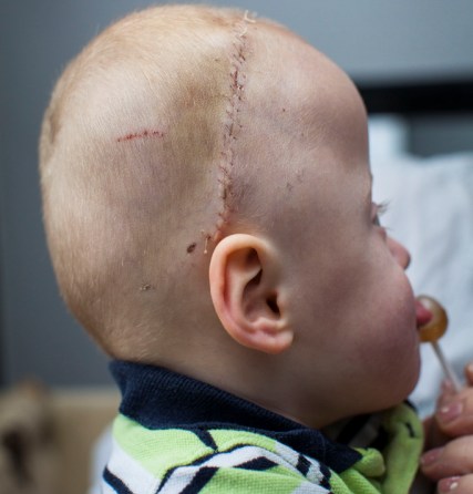 Le implantan resortes en el cráneo a un niño de 19 meses  - Cómo fue la intervención