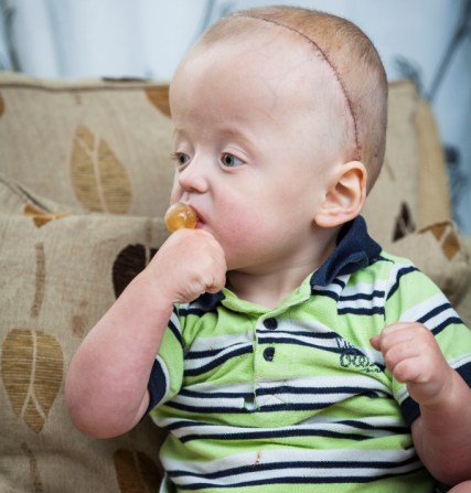 Le implantan resortes en el cráneo a un niño de 19 meses  - Cómo se trata este síndrome 