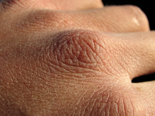 Una familia tiene la piel como papel tissue  - Síntomas de la ictiosis