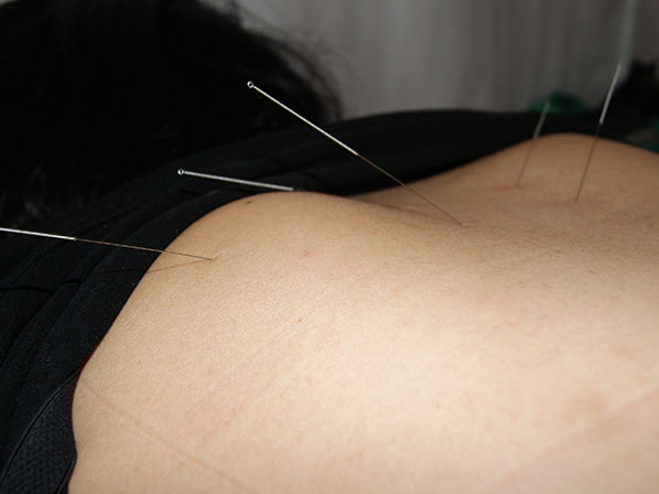 6 problemas que se solucionan con acupuntura -  ¿Cómo es el proceso?
