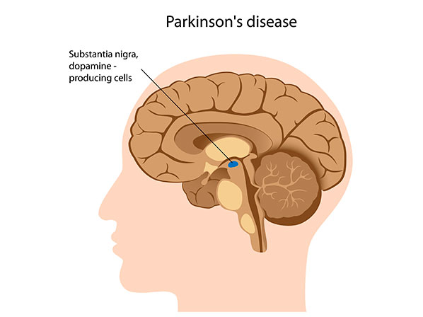 Famosos que viven con Parkinson - ¿Qué causa este enfermedad?