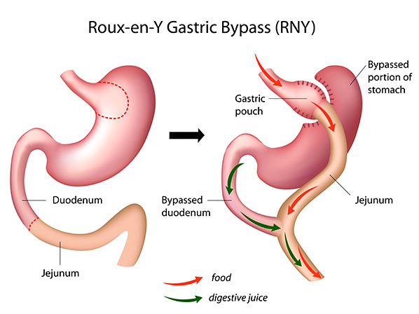 Famosos con cirugías excéntricas - ¿En qué consiste el “bypass gástrico”?