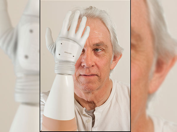 Las prótesis cambiaron sus vidas -  La primera persona con mano biónica en Reino Unido 