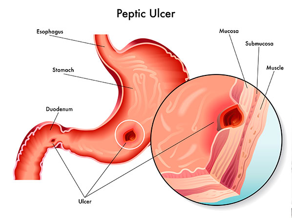 Los dolores de estómago más estelares - ¿Qué es una úlcera péptica?
