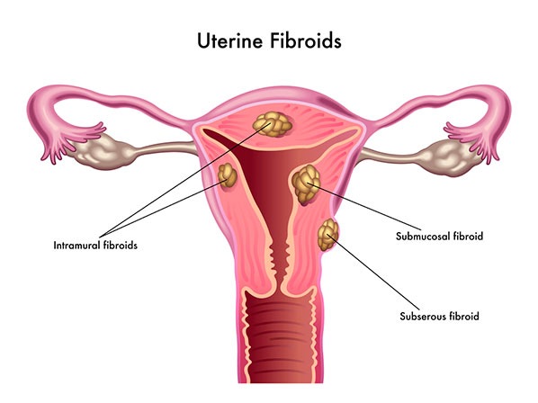  10: ¿Endometriosis o fibromas?