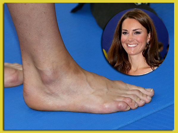 Los pies más horrorosos de la farándula - Kate Middleton: pies reales