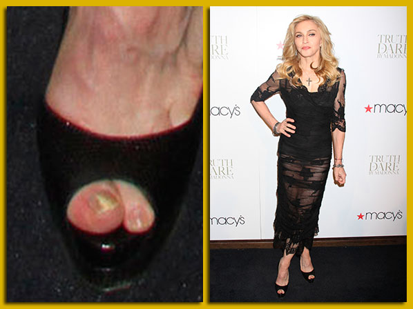 Los pies más horrorosos de la farándula - Madonna y sus hongos