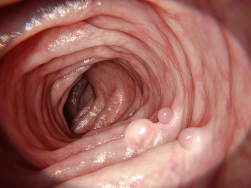El cáncer de colon puede ser curable - ¿Por qué es importante la detección precoz?