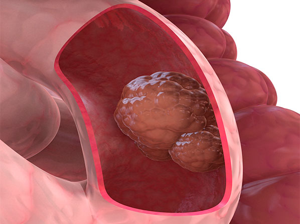 El cáncer de colon puede ser curable - ¿Cómo se origina?
