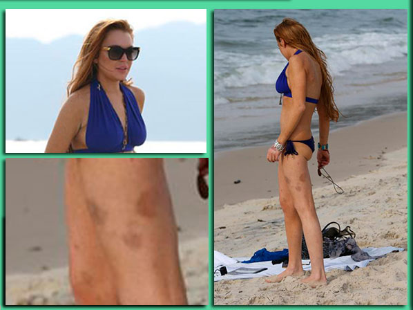 Moretones: ni los famosos se salvan - Lindsay Lohan: moretones en las piernas