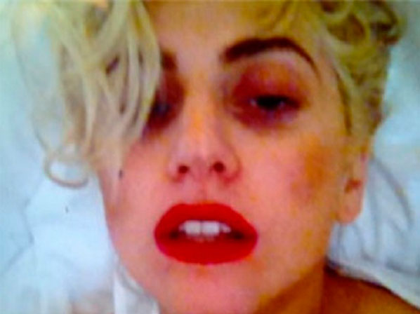 Moretones: ni los famosos se salvan - Lady Gaga, los gajes del oficio