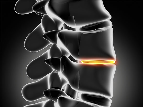 Mujer se rompe la espalda y de “milagro” vuelve a caminar - Artrodesis vertebral