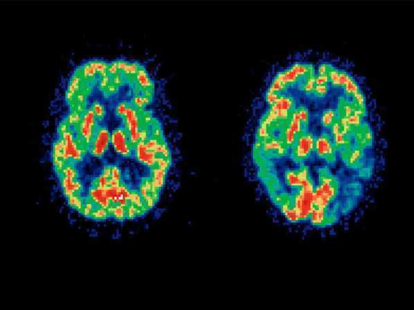 10 increíbles hallazgos sobre Alzheimer - 2. Biomarcadores que la predicen 