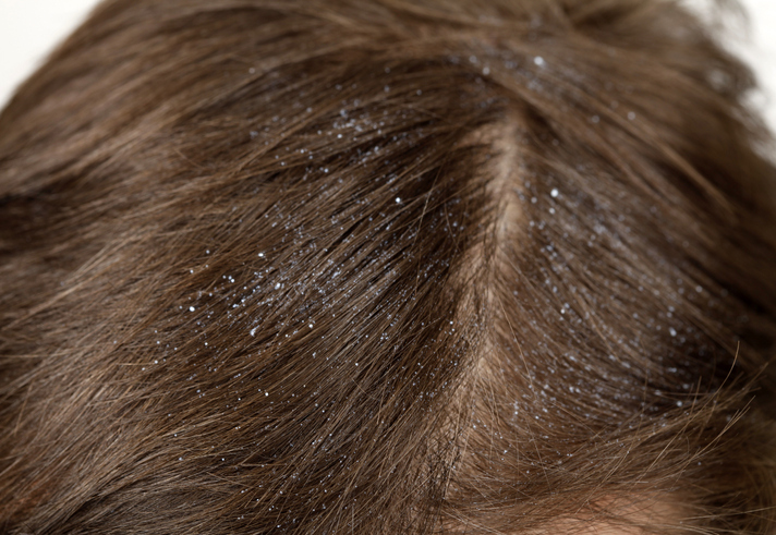 Remedios caseros para los distintos problemas del cabello - Caspa