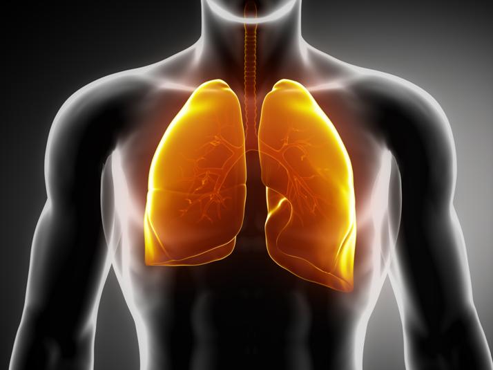 Las 5 enfermedades peor diagnosticadas - 4: Embolia pulmonar 