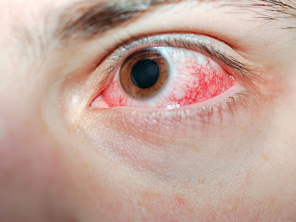 10 cambios inesperados en tu cuerpo que dan miedo - 9: Venas rojas en el ojo
