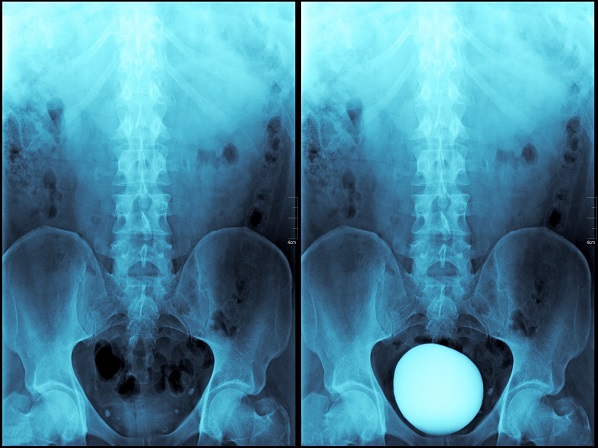 Signos de que puede faltarte testosterona - Osteoporosis
