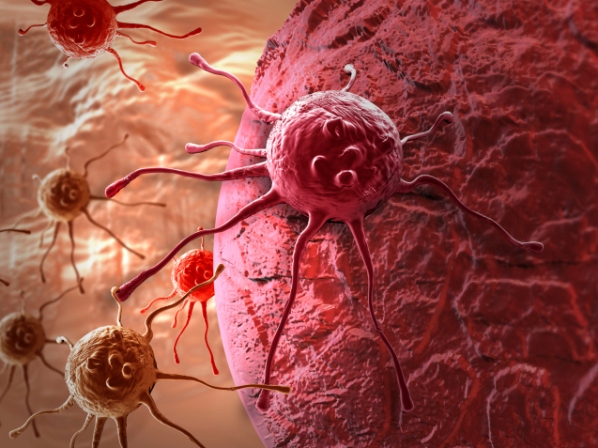 Aprende todo sobre el cáncer de ovarios - ¿Qué es el cáncer ovárico? 