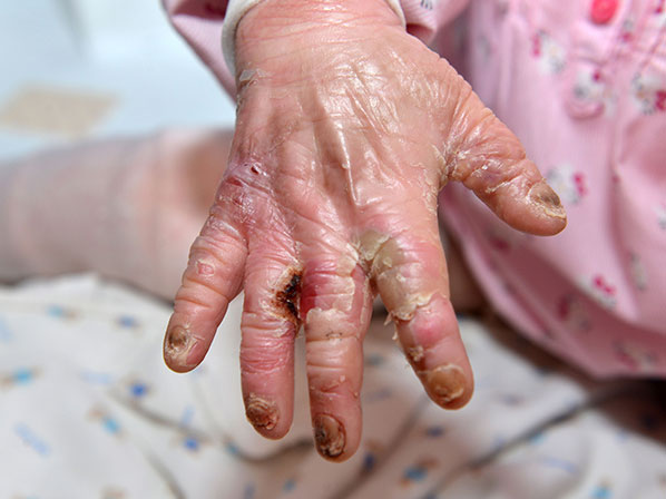 Nena con rara enfermedad, su madre no la puede tocar - Dedos pegajosos