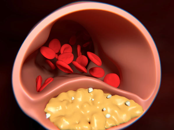 9 nuevas reglas para bajar el colesterol - No sólo en el corazón