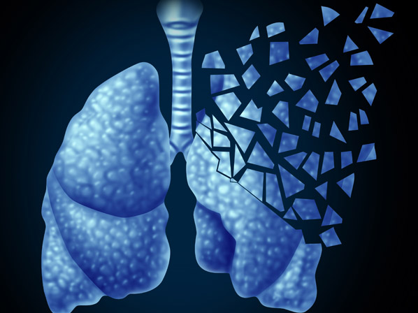 Cáncer de pulmón: lo que necesitas saber - Cifras alarmantes
