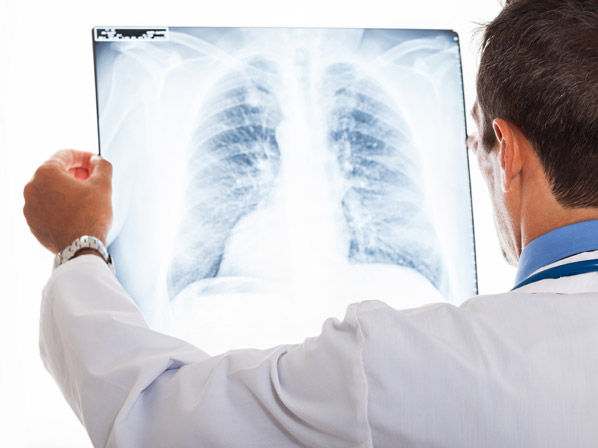 Cáncer de pulmón: lo que necesitas saber - ¿Cómo se diagnostica?