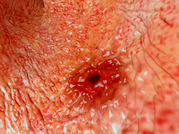 Las enfermedades de los famosos en este 2013 - Úlcera péptica