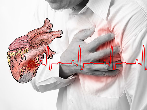 Las muertes que marcaron el 2013 - ¿En qué consiste un infarto?