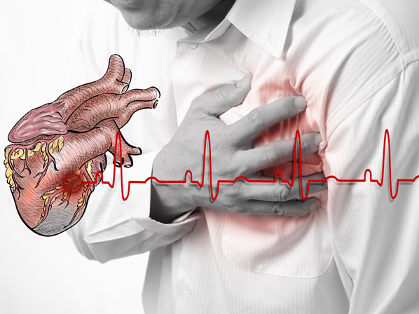 ¿Sabes reconocer los síntomas de un infarto?