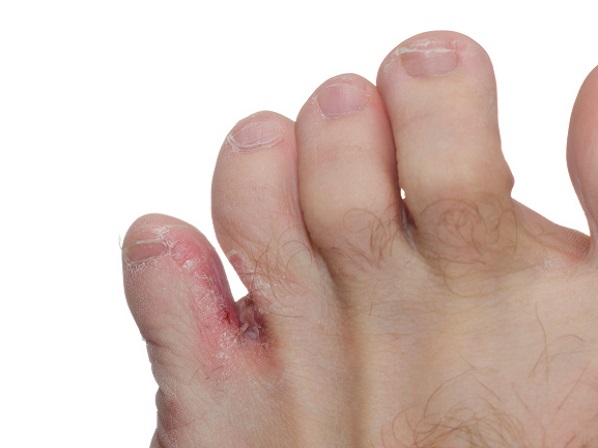 Cómo evitar infecciones si vas al pedicuro - ¿Qué es el pie de atleta?
