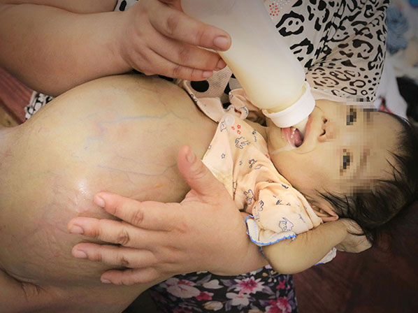 Los bebés con las anomalías más extrañas - Atresia biliar