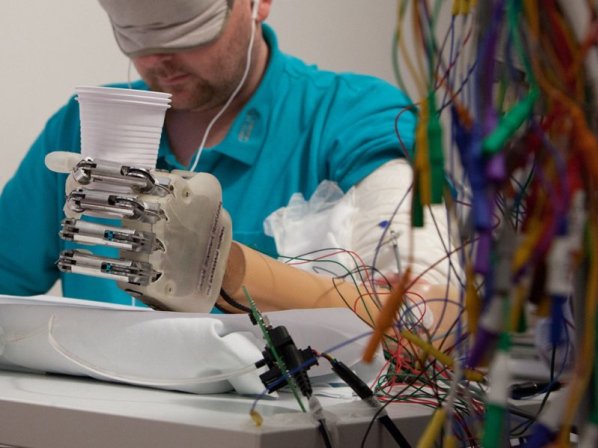 10 trasplantes médicos asombrosos - 9. Le implantaron una mano robótica 