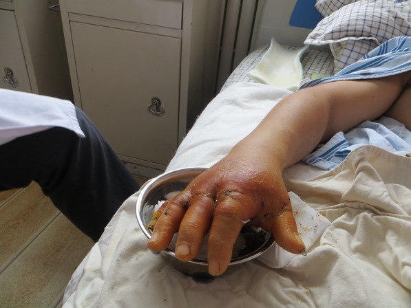 10 trasplantes médicos asombrosos - 8. Volvió a recuperar sus dedos