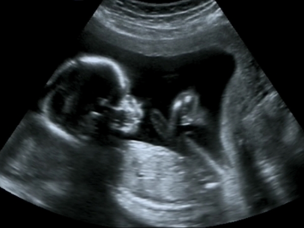 Estuvo “muerta” 3 minutos en el parto y revivió - ¿Qué es la placenta previa?