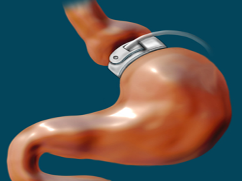 10 cosas que debes saber sobre la cirugía bariátrica - ¿Qué es la banda gástrica ajustable?