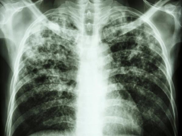Seis enfermedades que podrían matar a millones - 6. Tuberculosis