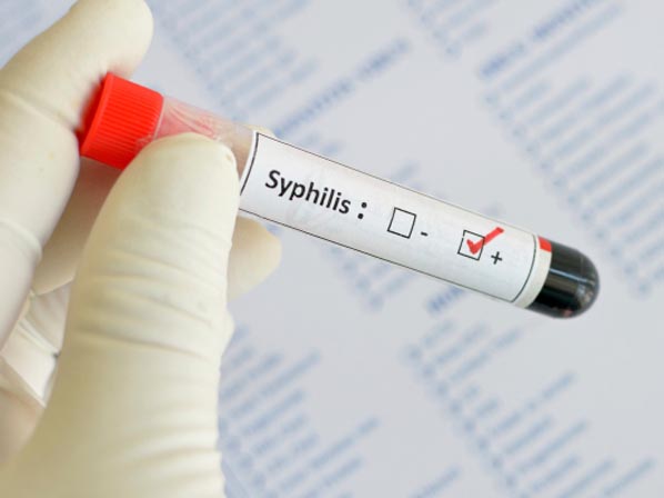 Seis enfermedades que podrían matar a millones - 5. Sífilis