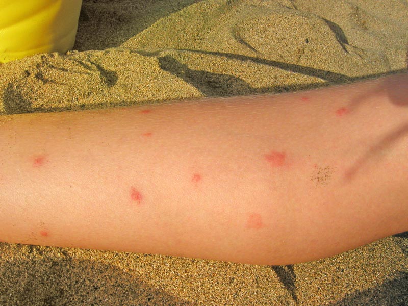 Virus chikungunya: ¿se puede frenar? - Hay que cubrirse